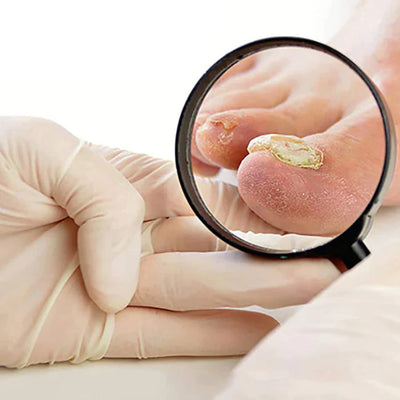 Anti-Paronychia Hulpolie | 1+1 GRATIS